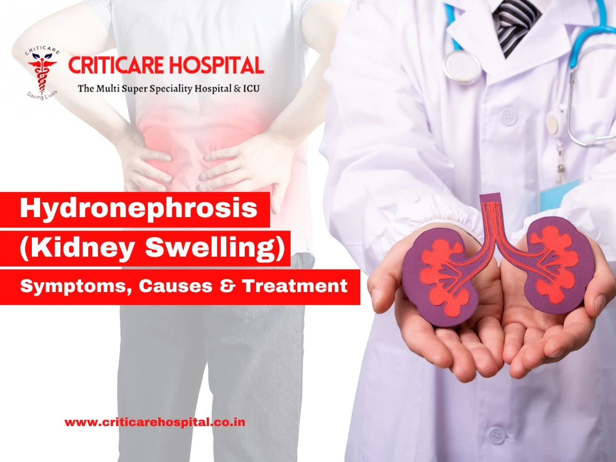 Hydronephrosis (Kidney Swelling): Symptoms, Causes & Treatment