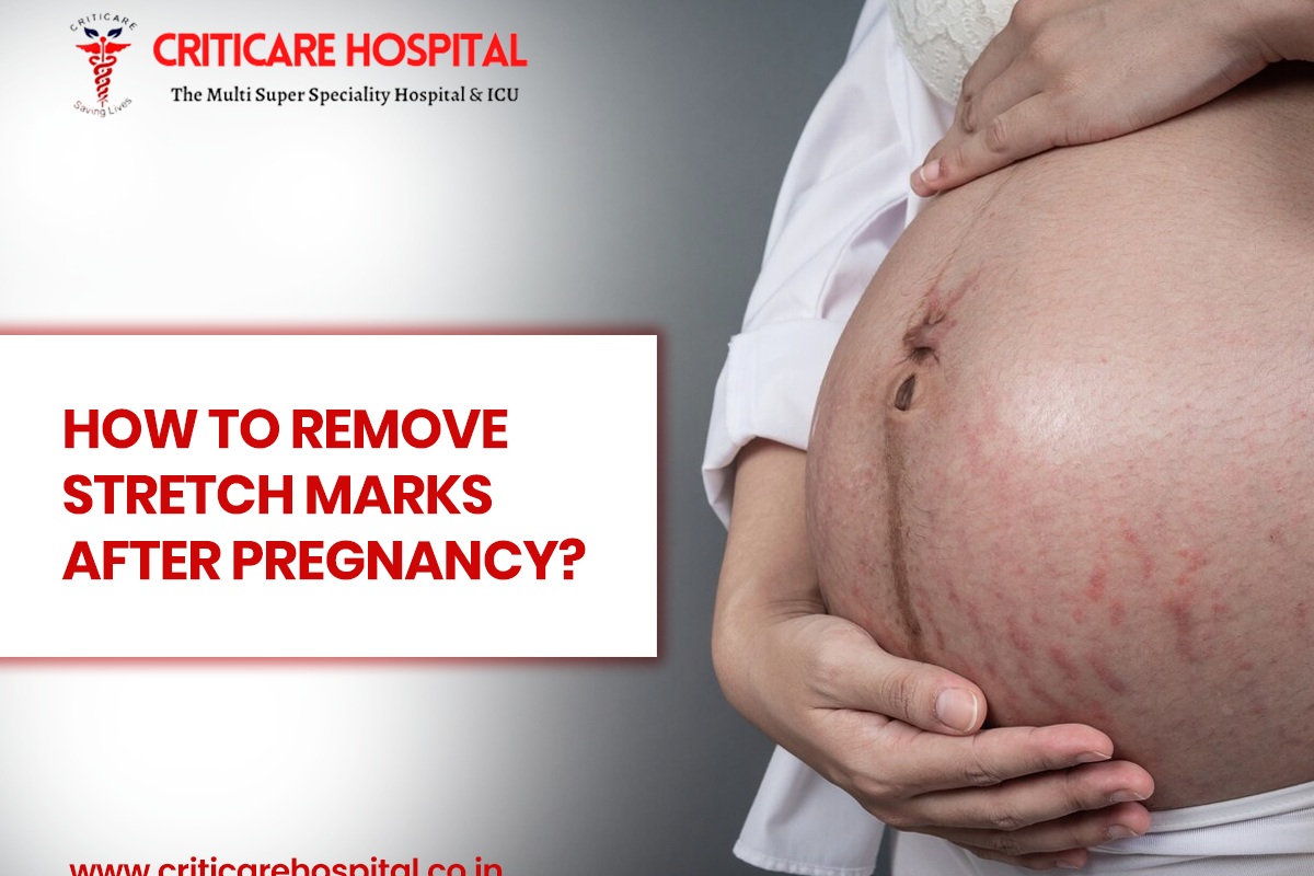 How To Remove Stretch Marks After Pregnancy?