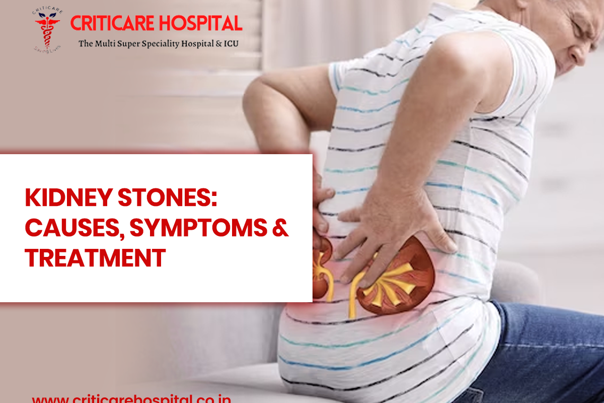 Kidney Stones: Causes, Symptoms & Treatment