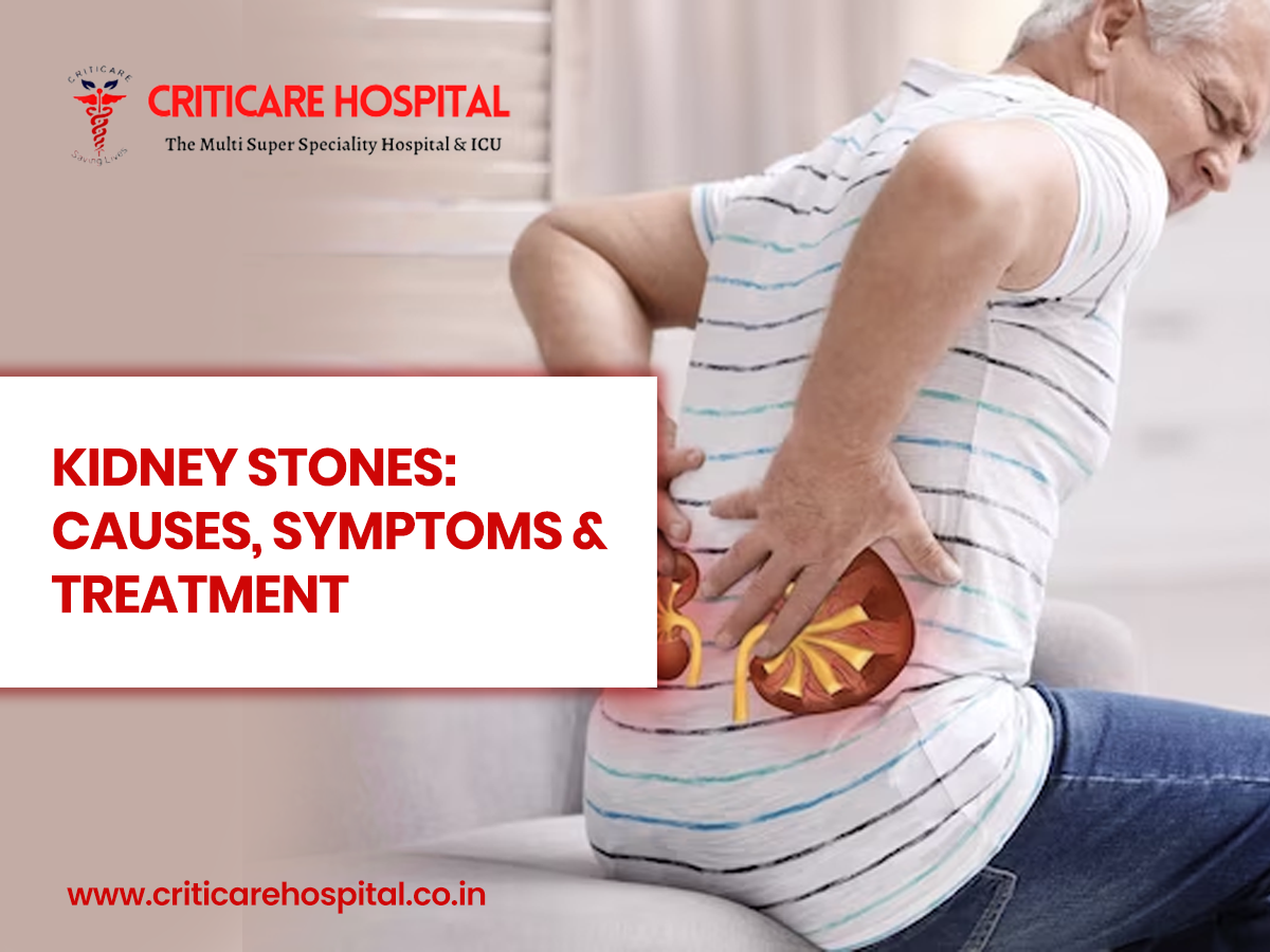 Kidney Stones: Causes, Symptoms & Treatment