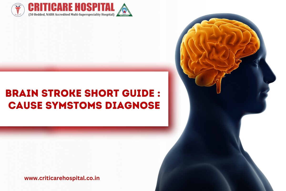 Brain Stroke Short Guide