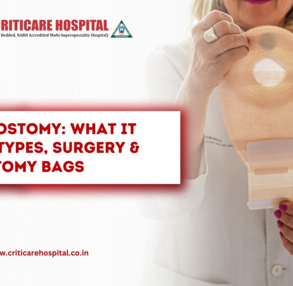 Ileostomy