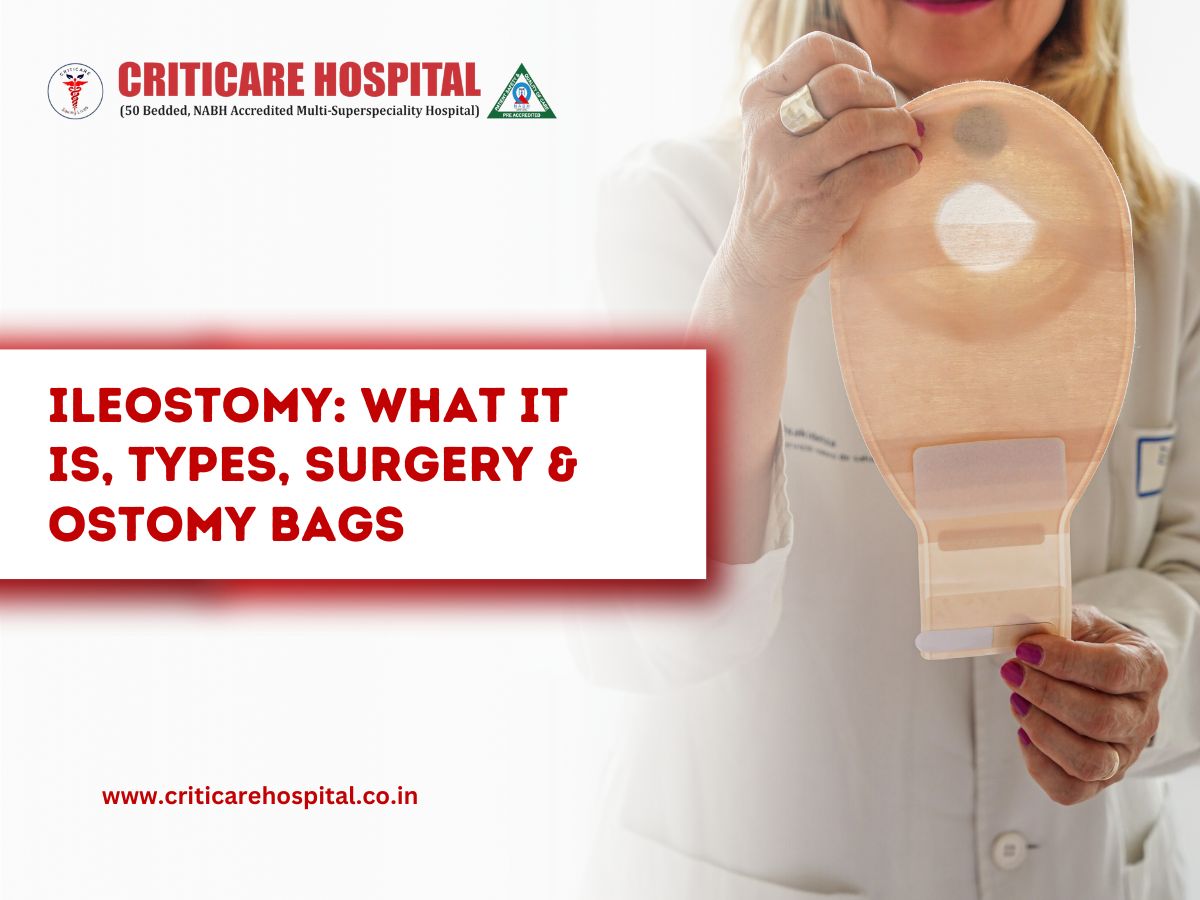 Ileostomy
